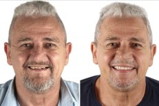 نتائج قبل وبعد زراعة الأسنان – ابتسامة محسنة واستعادة الأسنان