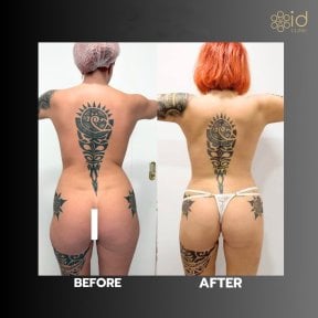 before-after photo vaser-liposuction