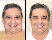 نتائج قبل وبعد زراعة الأسنان – ابتسامة مستعادة وتحول في الأسنان