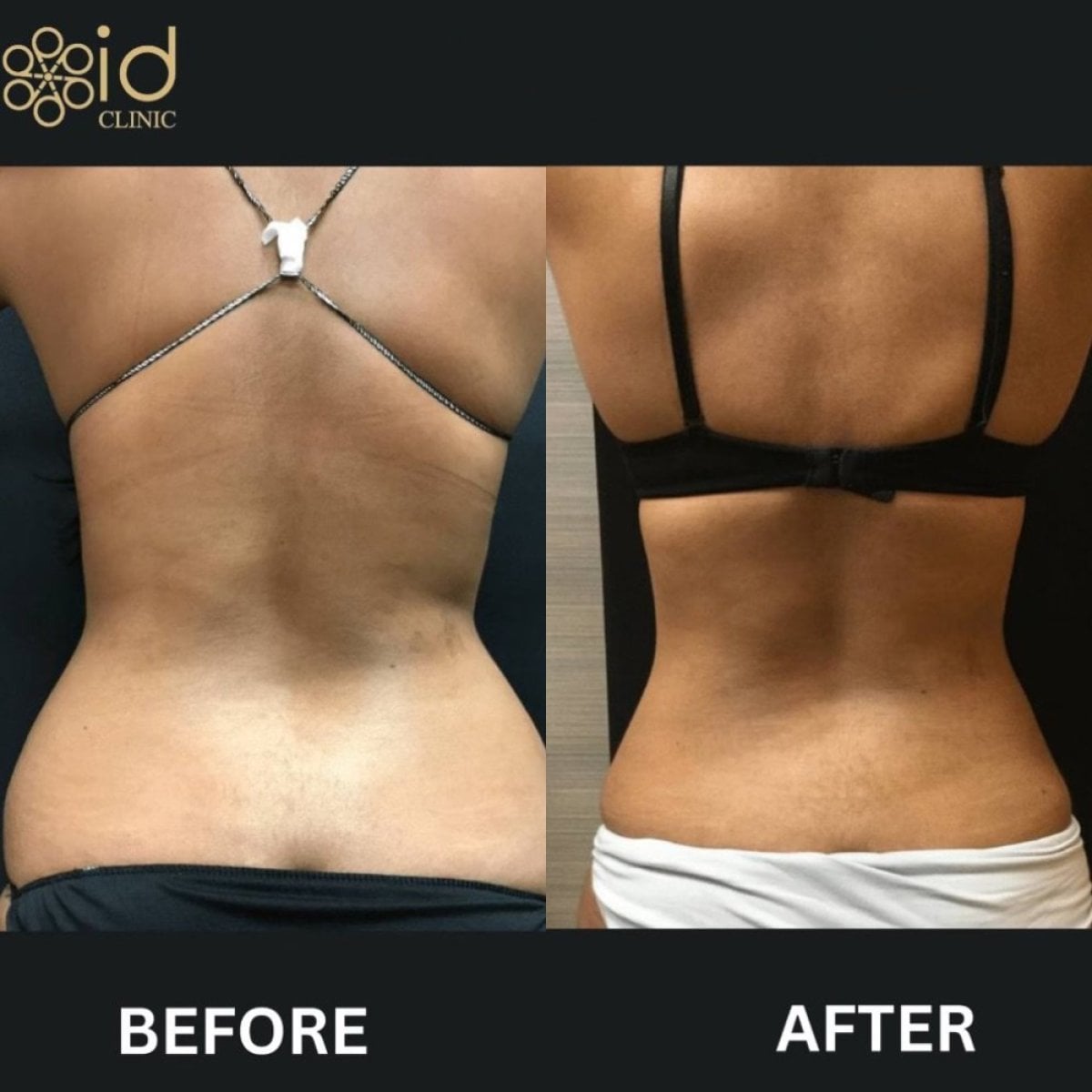 Resultados antes y después de Vaser liposucción en ID Clinic Bangkok, contorno de cintura mejorado