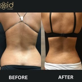 before-after photo vaser-liposuction