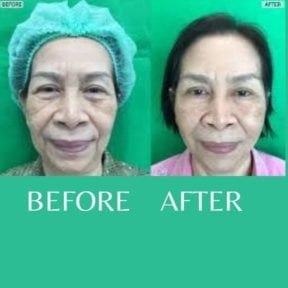 before-after photo mini-facelift