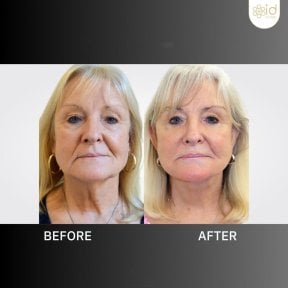 before-after photo mini-facelift