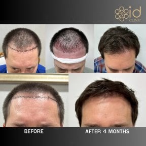 before-after photo dhi-hair-transplantation