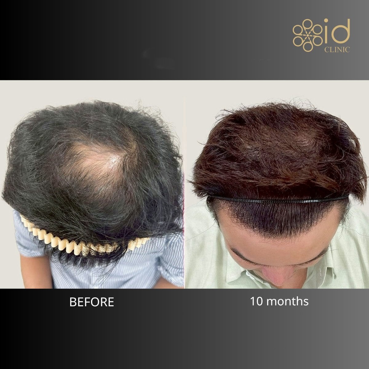 Resultado antes y después de trasplante capilar DHI en ID Clinic Bangkok, mayor densidad capilar