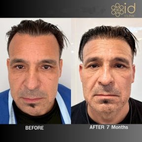 before-after photo dhi-hair-transplantation