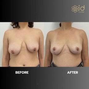 before-after photo mastopexy-breast-lift-contour-plastics