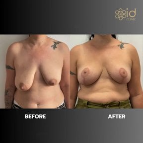 before-after photo mastopexy-breast-lift-contour-plastics