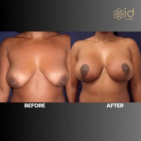 before-after photo mastopexy-breast-lift-contour-plastics