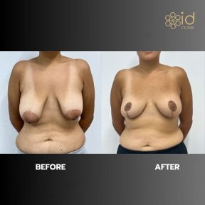 before-after photo mastopexy-breast-lift-contour-plastics