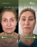 Before and after full face and neck lift with fat grafting results at Medolea Clinic