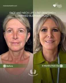 Before and after deep plane facelift results at Dr. Safa Manav Clinic, visible facial rejuvenation