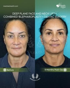 Before and after deep plane facelift, neck lift, blepharoplasty at Dr. Safa Manav Clinic results