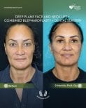 Before and after deep plane facelift, neck lift, blepharoplasty at Dr. Safa Manav Clinic results
