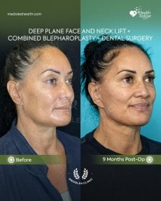 Before and after deep plane facelift and neck lift results at Dr. Safa Manav Clinic