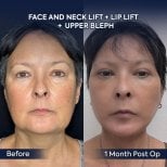 Before and after facelift, neck lift, lip lift, upper blepharoplasty at Dr. Safa Manav Clinic
