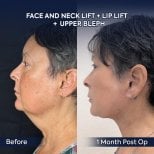 Facelift and neck lift before and after results at Dr. Safa Manav Clinic, visible rejuvenation