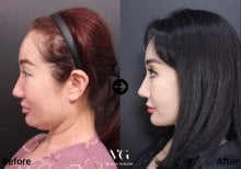 Vorher-nachher-Ergebnis Facelift bei VG Plastic Surgery – sichtbare Kiefer- und Halspartie