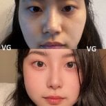 Résultat avant/après rhinoplastie du nez bulbeux chez VG Plastic Surgery, nez affiné