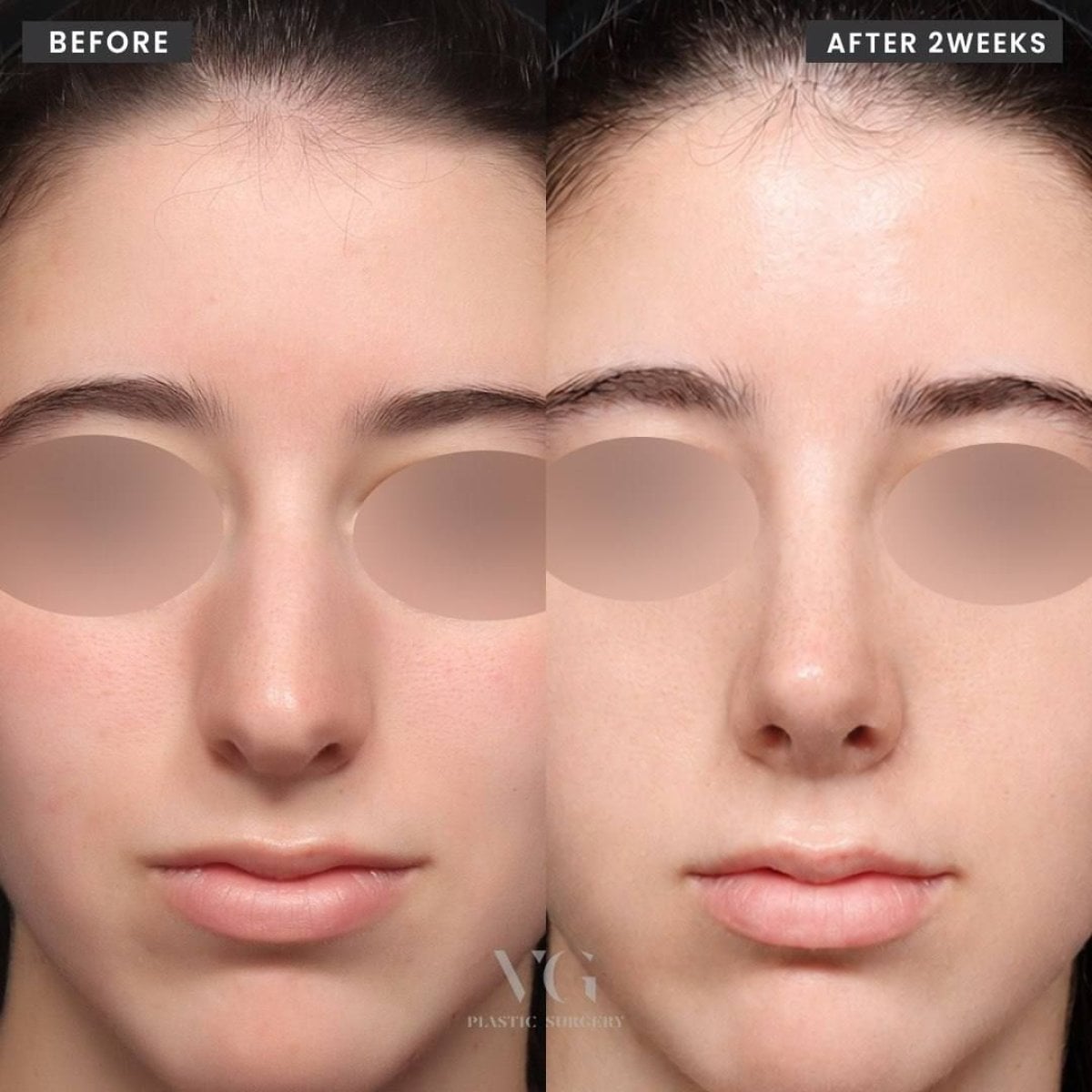 نتيجة تجميل الأنف المنتفخ قبل وبعد في VG Plastic Surgery بعد أسبوعين من الجراحة