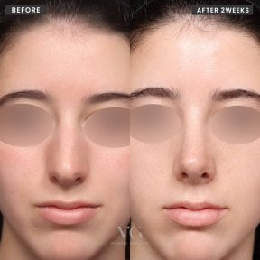Résultat avant/après rhinoplastie du nez bulbeux chez VG Plastic Surgery, 2 semaines