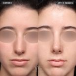 Résultat avant/après rhinoplastie du nez bulbeux chez VG Plastic Surgery, 2 semaines