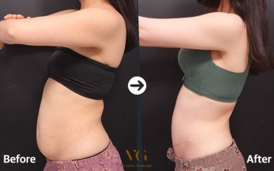 Resultados de liposucción 360 antes y después en VG Plastic Surgery – cintura más delgada