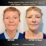 Before and after deep plane facelift and eyelid surgery results at ID Clinic Bangkok