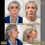 Before and after deep plane facelift and neck lift results at ID Clinic Bangkok, 30 days post-op