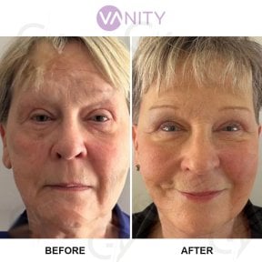 Результати до і після підтяжки обличчя у Vanity Cosmetic Surgery Hospital, омолодження