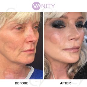 Результати до і після підтяжки обличчя у Vanity Cosmetic Surgery Hospital, омолодження