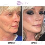 Результати до і після підтяжки обличчя у Vanity Cosmetic Surgery Hospital, омолодження