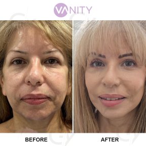 Результати до і після підтяжки обличчя у Vanity Cosmetic Surgery Hospital, омолодження обличчя