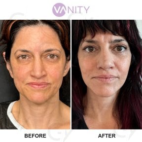 Результати до і після підтяжки обличчя у Vanity Cosmetic Surgery Hospital, омолодження