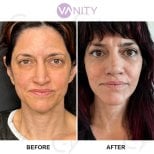Результати до і після підтяжки обличчя у Vanity Cosmetic Surgery Hospital, омолодження