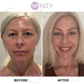 Результати до і після підтяжки обличчя у Vanity Cosmetic Surgery Hospital, омолодження