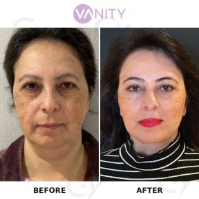 Результати до і після підтяжки обличчя у Vanity Cosmetic Surgery Hospital, помітне омолодження
