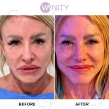 Результати до і після підтяжки обличчя у Vanity Cosmetic Surgery Hospital, омолодження