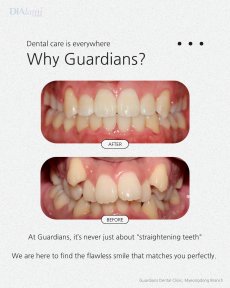 Before and after braces results at Guardians Dental Clinic – improved teeth alignment