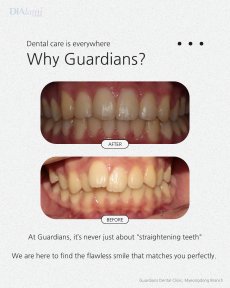 Before and after braces results at Guardians Dental Clinic – improved teeth alignment