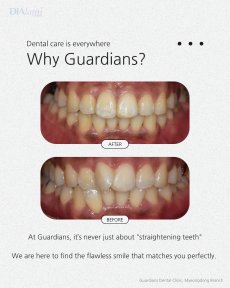 Before and after braces results at Guardians Dental Clinic – straighter teeth and improved smile