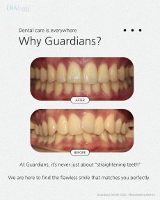 Before and after braces results at Guardians Dental Clinic – improved teeth alignment