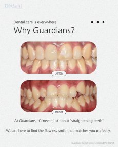 Before and after braces results at Guardians Dental Clinic – improved teeth alignment