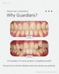 Before and after braces results at Guardians Dental Clinic – improved teeth alignment