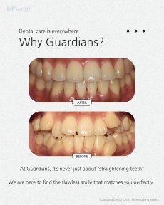 Before and after braces results at Guardians Dental Clinic – straighter teeth and improved smile