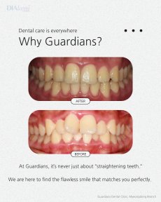 Before and after braces results at Guardians Dental Clinic – improved teeth alignment