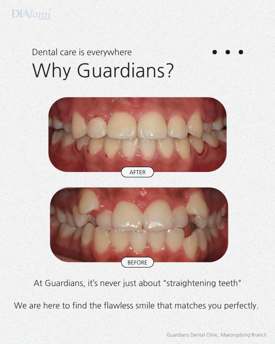 Resultados antes y después de brackets en Guardians Dental Clinic – alineación dental mejorada