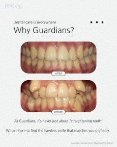 Before and after braces results at Guardians Dental Clinic – improved teeth alignment