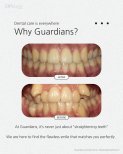Before and after braces results at Guardians Dental Clinic – improved teeth alignment