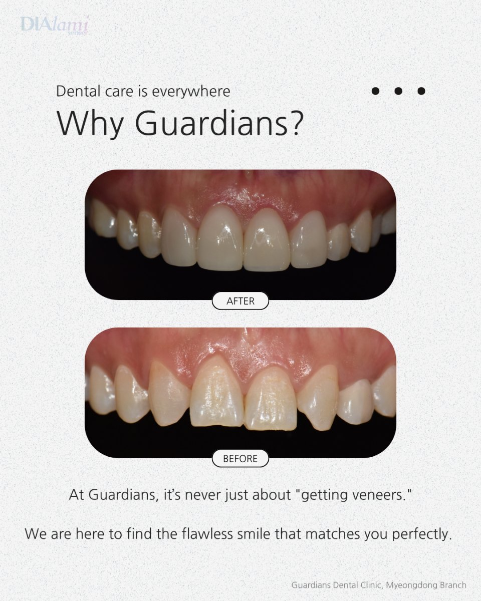نتيجة قبل وبعد الفينير في Guardians Dental Clinic – تحول ملحوظ في الابتسامة